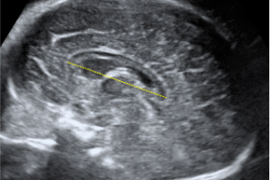 Cuerpo calloso medida